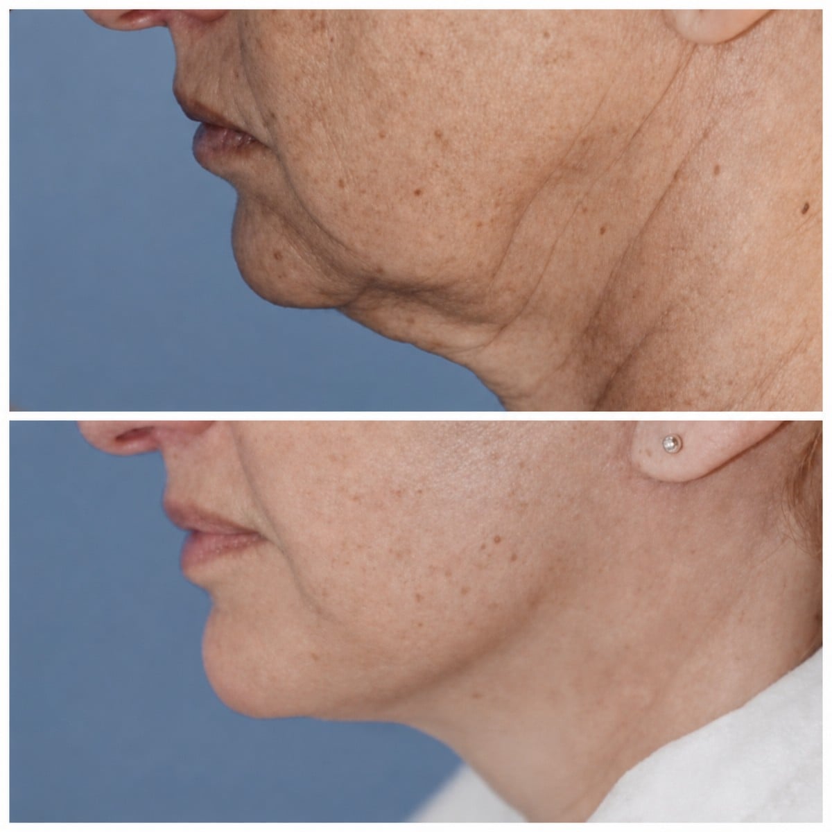 Resultados de lifting facial antes y después en Klinika Promedion – mandíbula definida