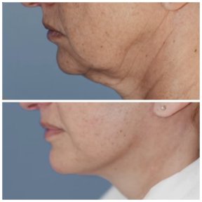 Facelift Vorher-Nachher-Ergebnis bei Klinika Promedion – straffere Kinnlinie und Hals