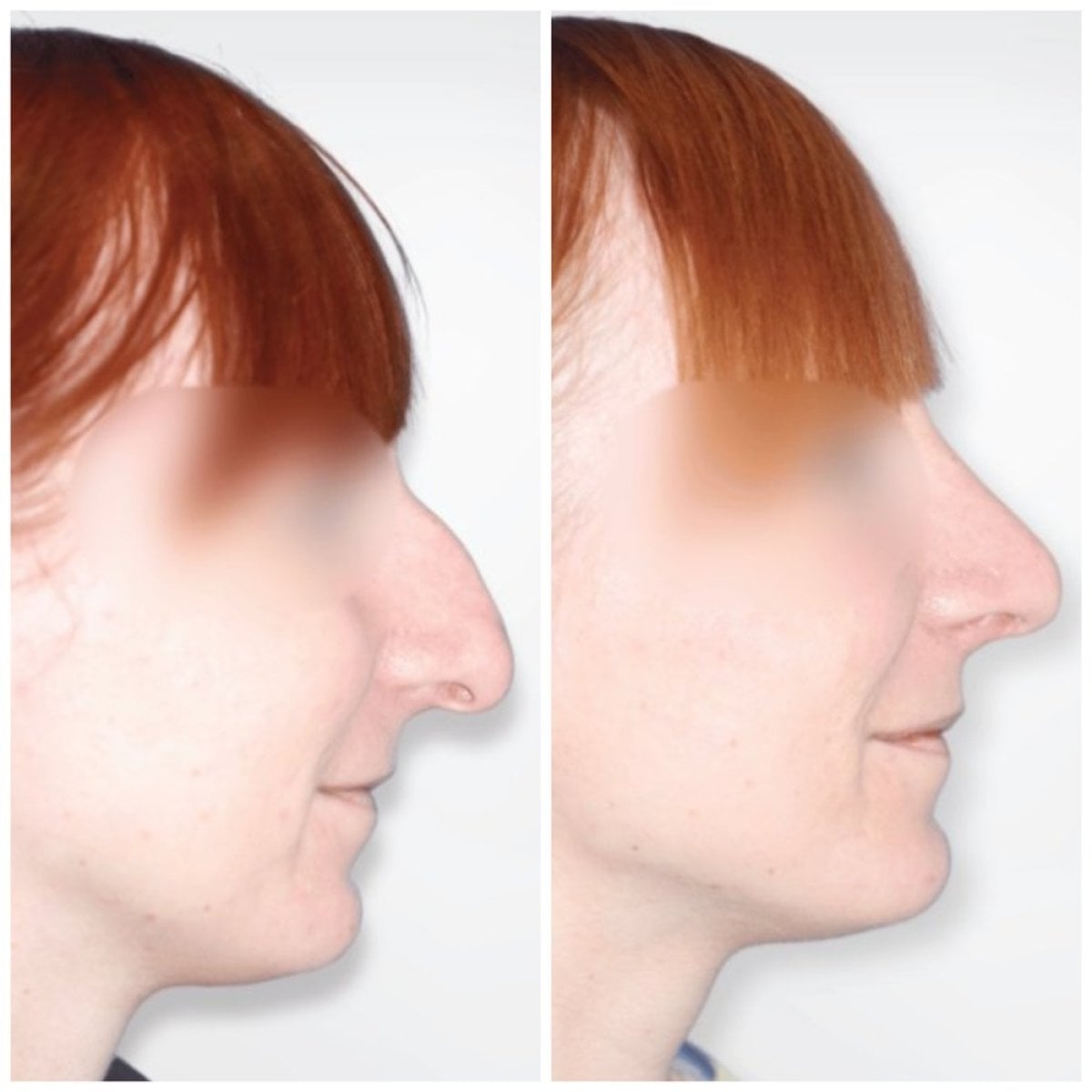 نتائج عملية تجميل الأنف قبل وبعد في Klinika Promedion، تحسين شكل الأنف والملف الجانبي