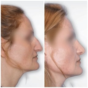 Before and after rhinoplasty results at Klinika Promedion, improved nose shape and profile