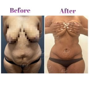 before-after photo abdominoplasty