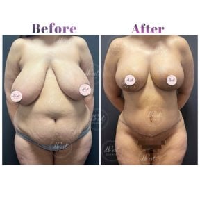 before-after photo abdominoplasty