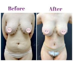 before-after photo abdominoplasty