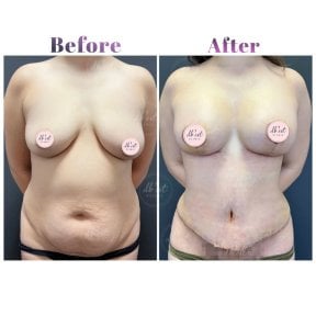 before-after photo abdominoplasty