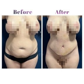 before-after photo abdominoplasty