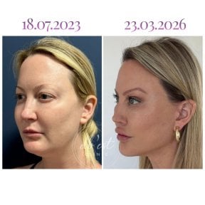 before-after photo deep-plane-facelift