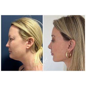 before-after photo deep-plane-facelift