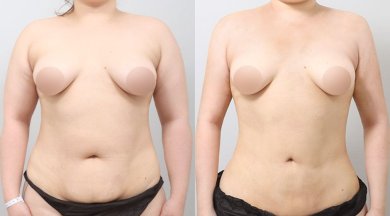 before-after photo liposakcia-zivota