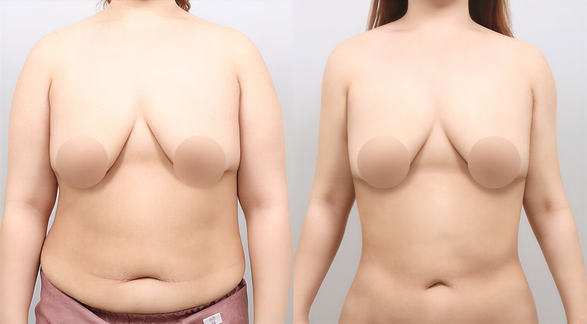 Resultados de liposucción abdominal antes y después en AB Plastic Surgery, cintura más delgada