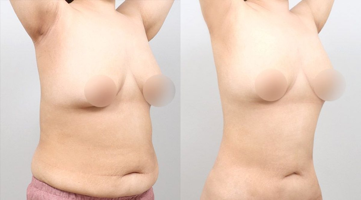 نتائج شفط دهون البطن قبل وبعد في AB Plastic Surgery – خصر أنحف