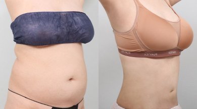 before-after photo liposakcia-zivota