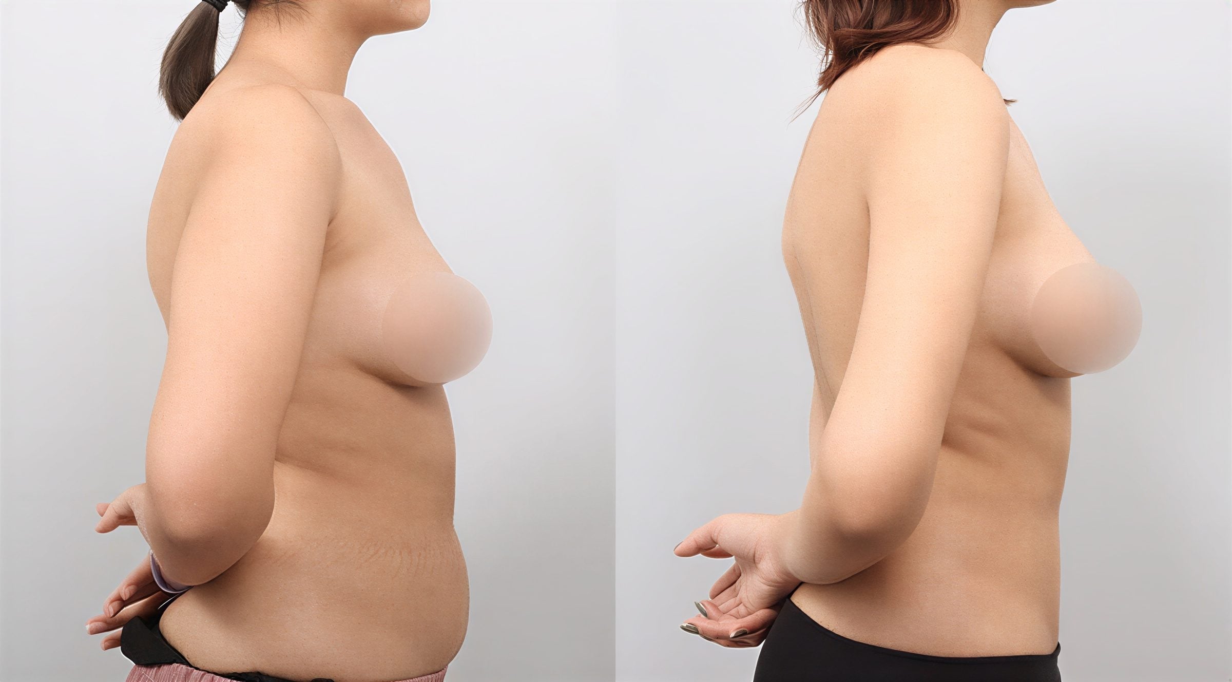 Resultados de liposucción abdominal antes y después en AB Plastic Surgery – cintura más delgada