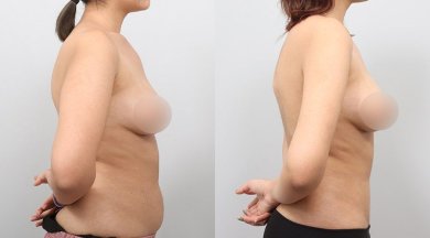 before-after photo liposakcia-zivota