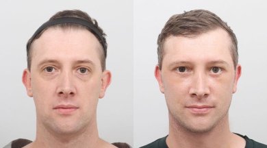 before-after photo podtazka-kozi-lica-fejslift
