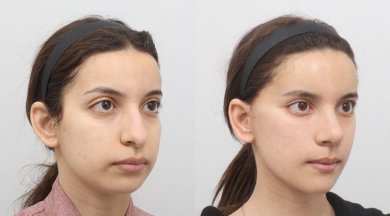 before-after photo podtazka-kozi-lica-fejslift