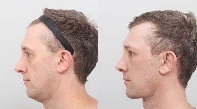 before-after photo podtazka-kozi-lica-fejslift