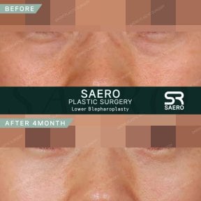 before-after photo upper-eyelid-surgery