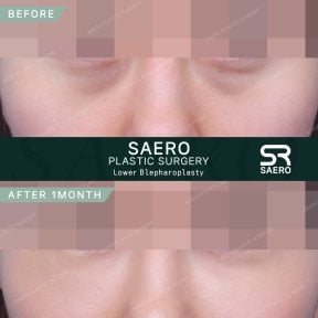 before-after photo upper-eyelid-surgery