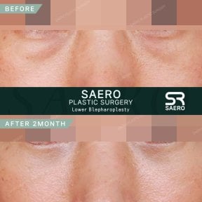 before-after photo upper-eyelid-surgery