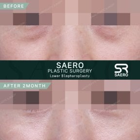 before-after photo upper-eyelid-surgery