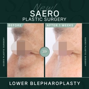 before-after photo upper-eyelid-surgery