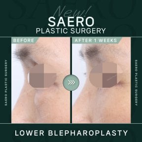 before-after photo upper-eyelid-surgery