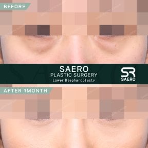 before-after photo upper-eyelid-surgery