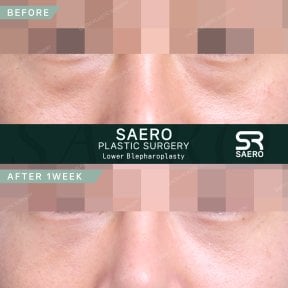 before-after photo upper-eyelid-surgery