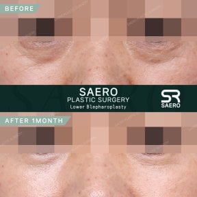 before-after photo upper-eyelid-surgery
