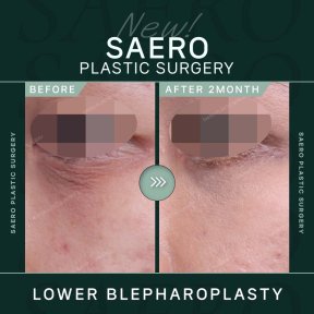 Lower eyelid blepharoplasty before and after results at SAERO Plastic Surgery, 2 months post-op