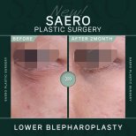 Lower eyelid blepharoplasty before and after results at SAERO Plastic Surgery, 2 months post-op