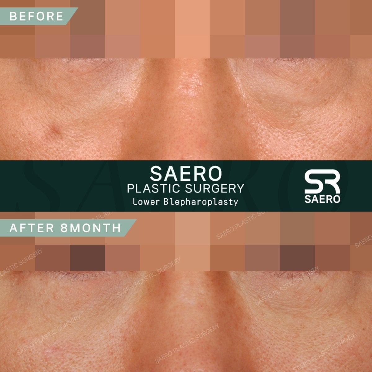 Resultados de blefaroplastia inferior antes y después en SAERO Plastic Surgery, 8 meses