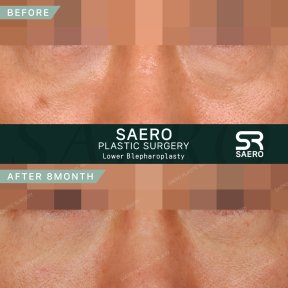 Lower eyelid blepharoplasty before and after results at SAERO Plastic Surgery, 8 months post-op