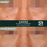 Lower eyelid blepharoplasty before and after results at SAERO Plastic Surgery, 8 months post-op