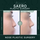 نتائج تجميل الأنف قبل وبعد في SAERO Plastic Surgery، تحسين شكل الأنف بعد شهر
