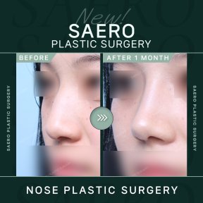 Before and after tip rhinoplasty results at SAERO Plastic Surgery, improved nose contour