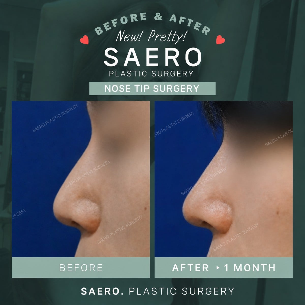 نتائج قبل وبعد تجميل طرف الأنف في SAERO Plastic Surgery، تحسين شكل الأنف
