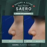 Before and after tip rhinoplasty results at SAERO Plastic Surgery, improved nose shape
