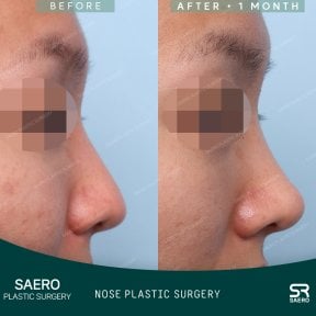 Before and after tip rhinoplasty results at SAERO Plastic Surgery, improved nose contour