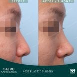 Before and after tip rhinoplasty results at SAERO Plastic Surgery, improved nose contour