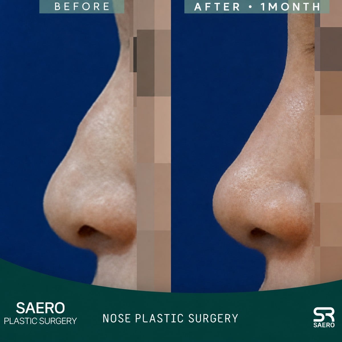 نتائج قبل وبعد عملية تجميل الأنف المغلقة في SAERO Plastic Surgery، تحسين شكل الأنف