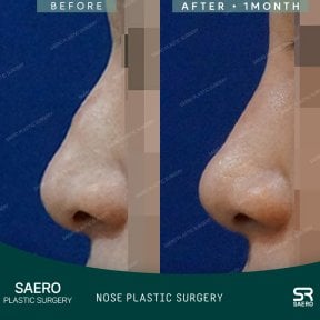 Vorher-nachher-Ergebnis der geschlossenen Rhinoplastik bei SAERO Plastic Surgery, verbesserte Nasenform