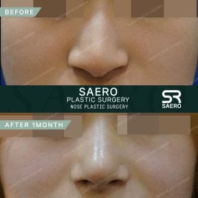 Vorher-nachher-Ergebnisse der geschlossenen Nasenkorrektur bei SAERO Plastic Surgery, verbesserte Nasenform