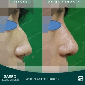 Vorher-nachher-Ergebnis der geschlossenen Nasenkorrektur bei SAERO Plastic Surgery, verbesserte Nasenform