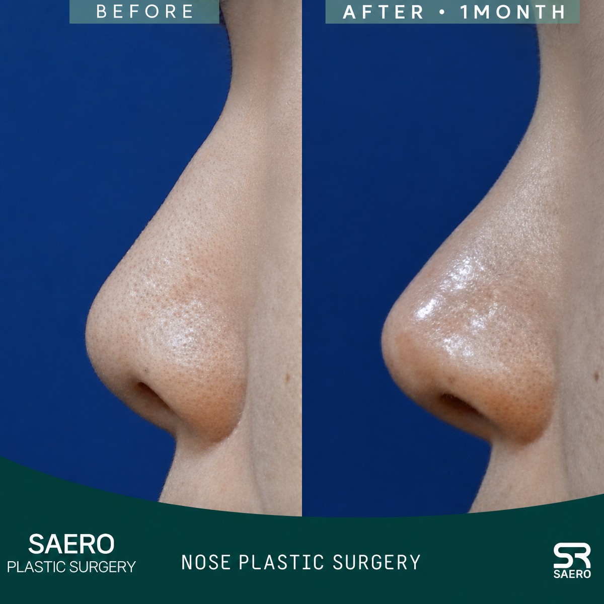 نتائج قبل وبعد عملية تجميل الأنف المغلقة في SAERO Plastic Surgery، تحسين شكل الأنف