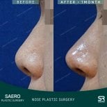 Vorher-nachher-Ergebnis der geschlossenen Rhinoplastik bei SAERO Plastic Surgery, verbesserte Nasenform