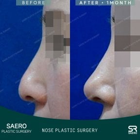 Vorher-nachher-Ergebnis der geschlossenen Nasenkorrektur bei SAERO Plastic Surgery, verbesserte Nasenform