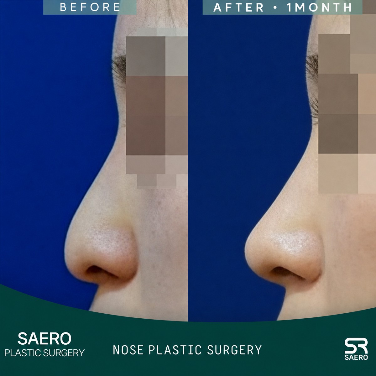 نتائج تجميل الأنف المغلق قبل وبعد في SAERO Plastic Surgery، تحسين شكل الأنف الجانبي