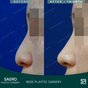 Vorher-nachher-Ergebnisse der geschlossenen Rhinoplastik bei SAERO Plastic Surgery, verbesserte Nasenprofil