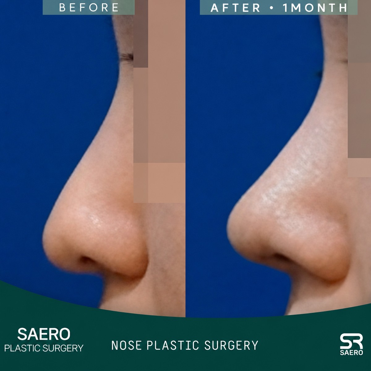 Resultados de rinoplastia cerrada antes y después en SAERO Plastic Surgery, perfil nasal mejorado